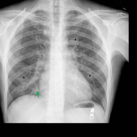 Chest X-Ray (AP and lateral view)