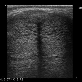 Axial bi-cavernosal image with dilated venous sinusoids