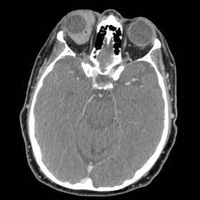 Orbital computed tomography (CT) with intravenous contrast