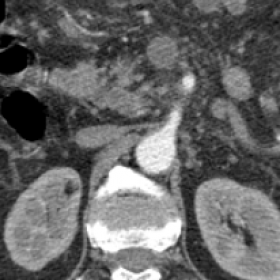 Abdominal CT arterial phase