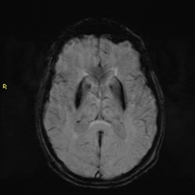 Brain MRI - SWI