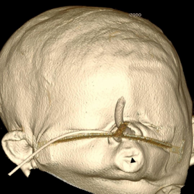 3D CT facial reconstruction