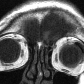 MRI coronal view