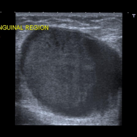 Left inguinal ultrasonography