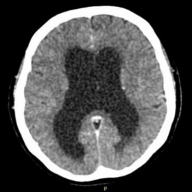 Emergency brain CT findings