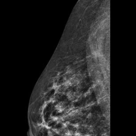 2D Mammogram (CC view) right breast