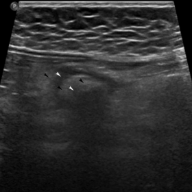 Abdominal ultrasound, axial image