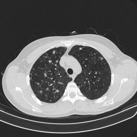 Chest CT (axial view)