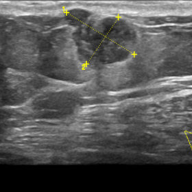 B-mode ultrasound: Hypoechoic mass with suspicious morphology