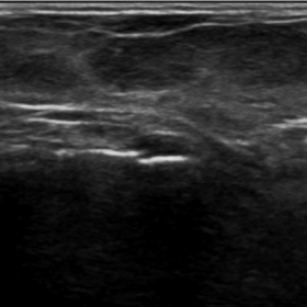 Ultrasound of ankle