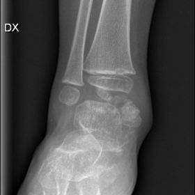 X-rays of the right ankle