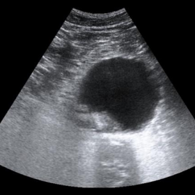 Abdominal ultrasound exam