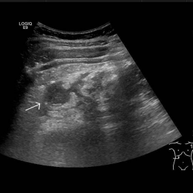 Abdominal ultrasound-RUQ