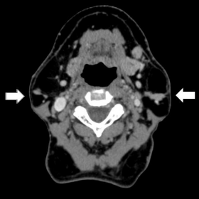 Contrast-enhanced CT scan in axial plane at the submaxillary level