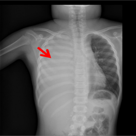 Massive pleural effusion on chest radiograph