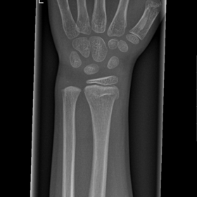 Radiograps of the left wrist after first trauma.