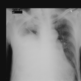 Chest Radiograph