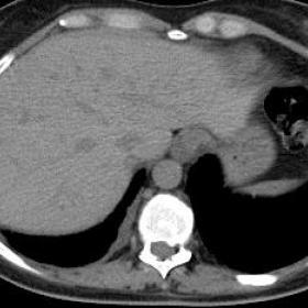 Chest CT scan without intravenous contrast medium