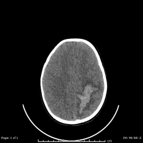 Non-contrast CT of the brain