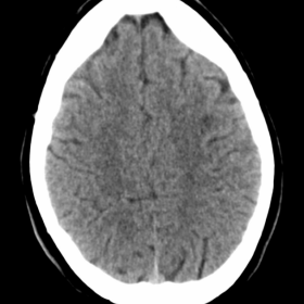 Head CT after seizures and resuscitation