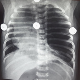 Anteroposterior chest X-ray