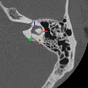 Normal anatomy of the inner ear on CT