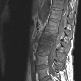 Lumbar spine MRI sagittal T1