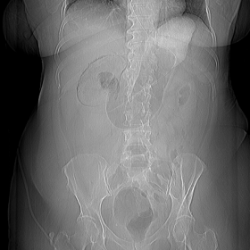 Plain X-ray of the abdomen at the emergency department