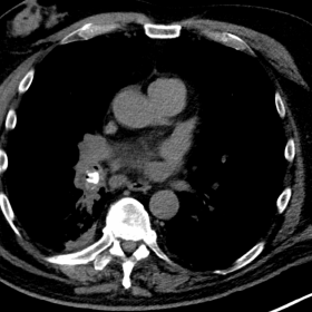 HRCT (The first chest CT)