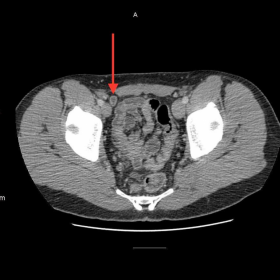 Patient A: Uncomplicated Meckel's diverticulum, axial CT