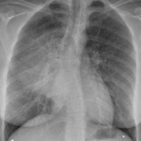 Conventional radiograph and CT of the chest