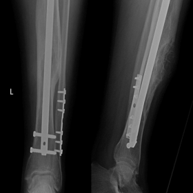 Anteroposterior (A) and lateral (B) radiograph of left leg