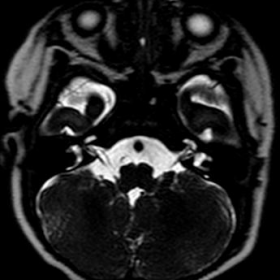 MRI brain axial CISS nerve sequence