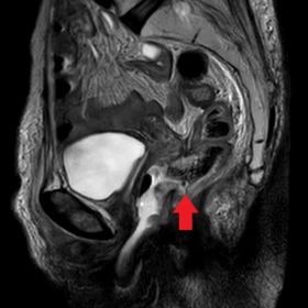 Sagittal T2WI of the pelvis