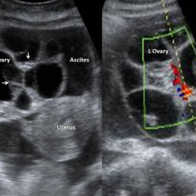 USG: Bilateral 'spoke-wheel' appearance of the ovaries