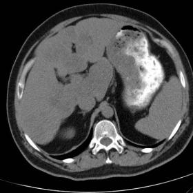 Axial NECT and CECT images of liver sarcoidosis
