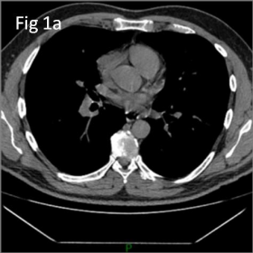 CT patterns of a pericardial diverticulum