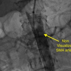 Conventional Angiography