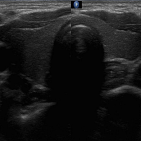 Ultrasound image of thyroid gland