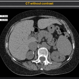 Fig1 - Unenhanced CT