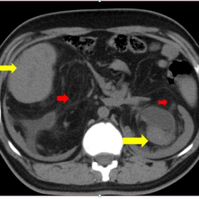 Axial plain CT abdomen.