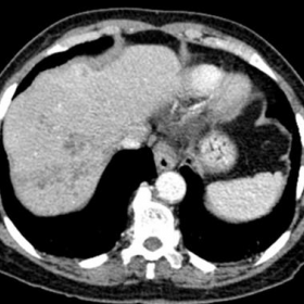 Post-contrast CT shows multiple liver abscesses with centripetal branching