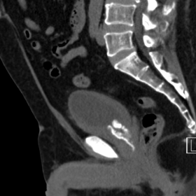 Unenhanced abdominal CT - sagittal and axial image
