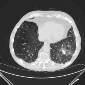 CT-thorax, lung window