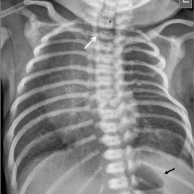 Chest radiograph with nasogastric tube in place