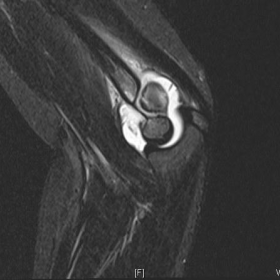T2-weighted sagittal image of the left elbow
