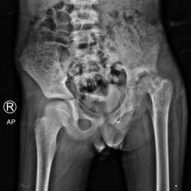 Plain radiograph of pelvis with both hip