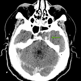 Axial CT image.