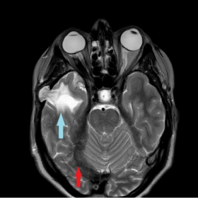 MRI head: Axial T2