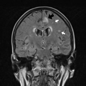Left cingulate lesion on FLAIR sequence before treatment